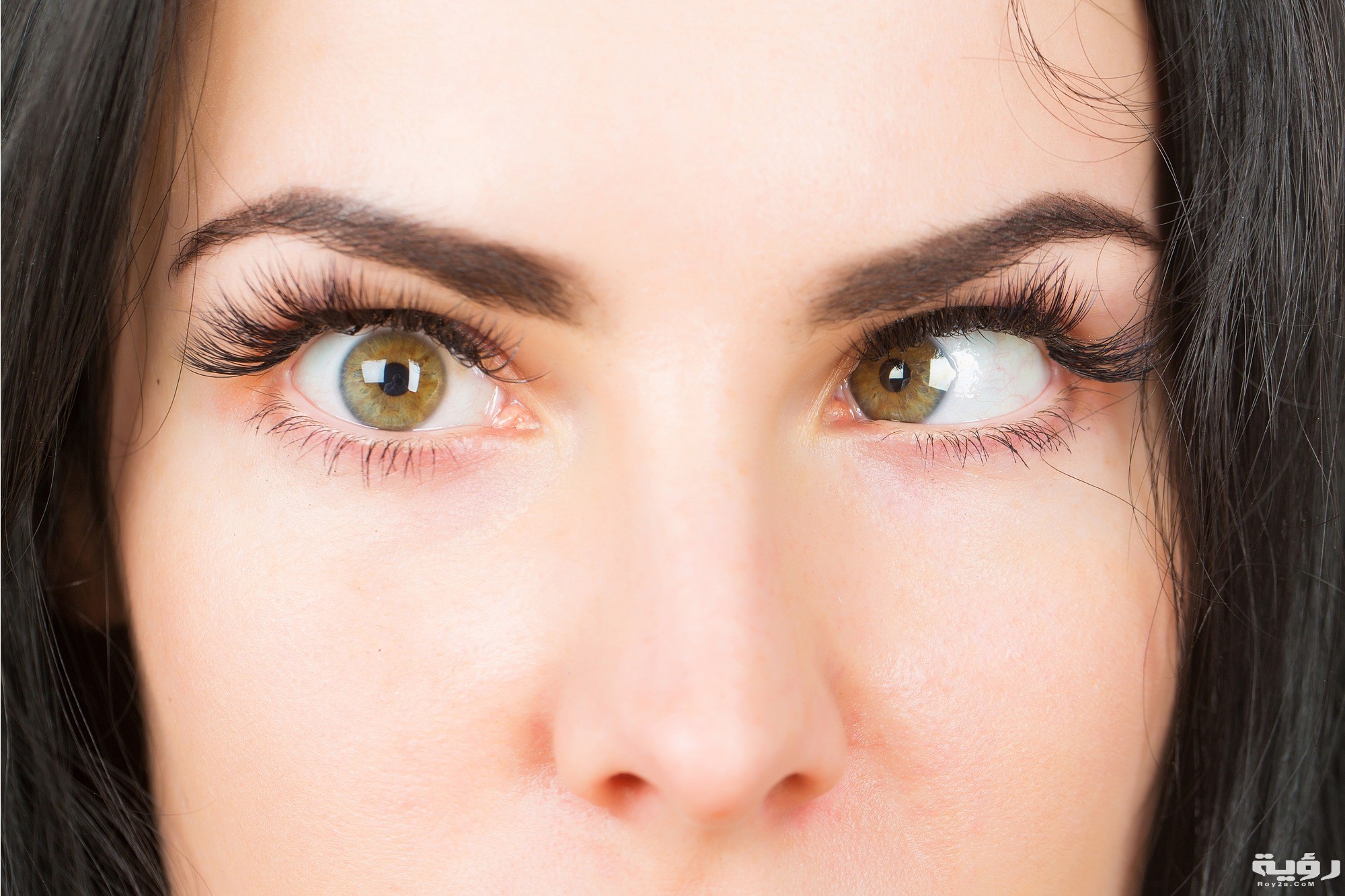 المرشح الأمثل لعلاج الحول