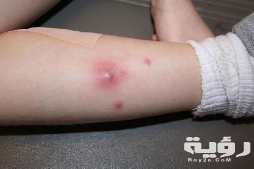 الدمامل في المنام