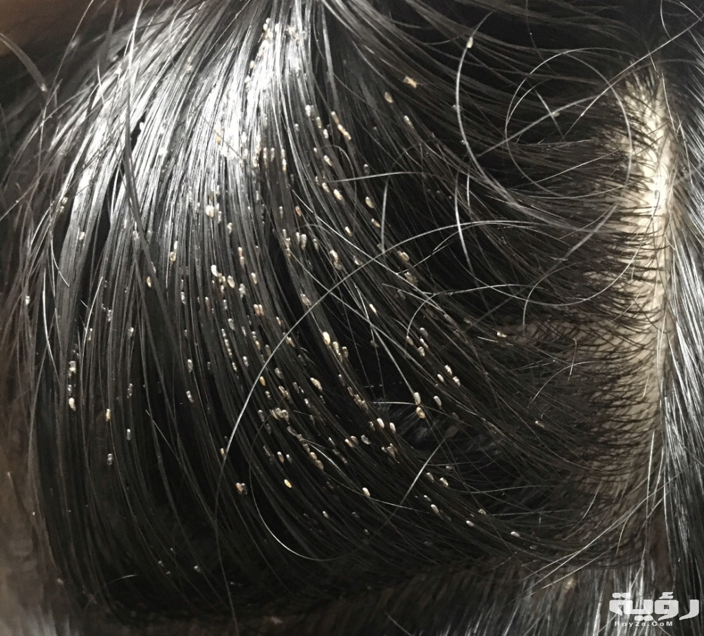 حلمت اني ينزل من شعري قمل 2 حلمت أني أخرج قمل من شعر أختي 5