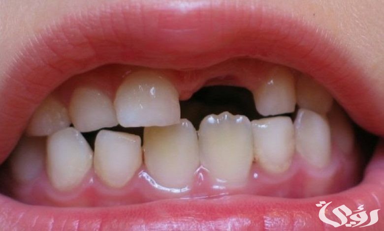 تفسير حلم سقوط السن الأمامي