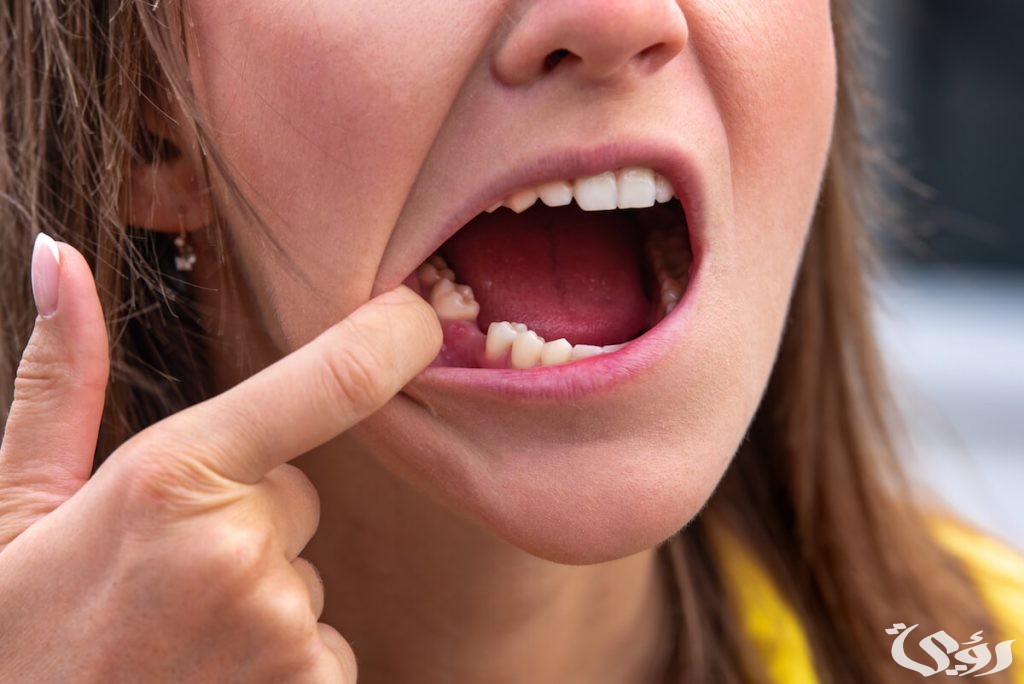 تفسير حلم سقوط الضرس العلوي