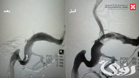 مستشفى الدكتور سليمان الحبيب بالخبر ينجح بزراعة دعامة دماغية لإنهاء معاناة استمرت 4 سنوات لخمسينية من طنين الأذن النابض