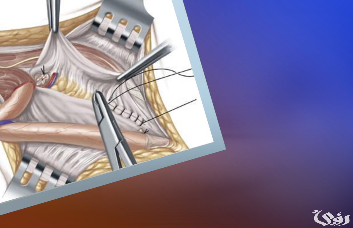 تكلفة عملية الفتق في السعودية مع التجارب