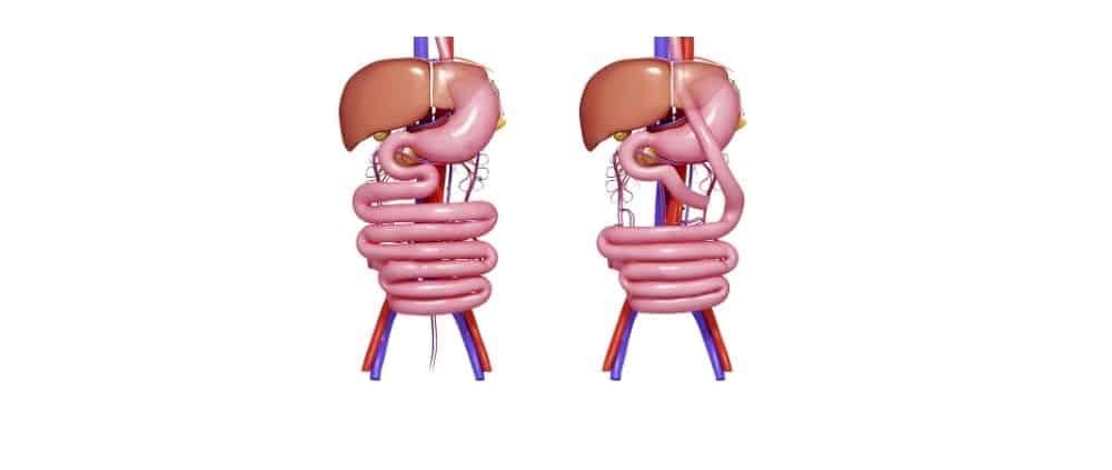 تكلفة عملية تحويل مسار المعدة في الكويت 