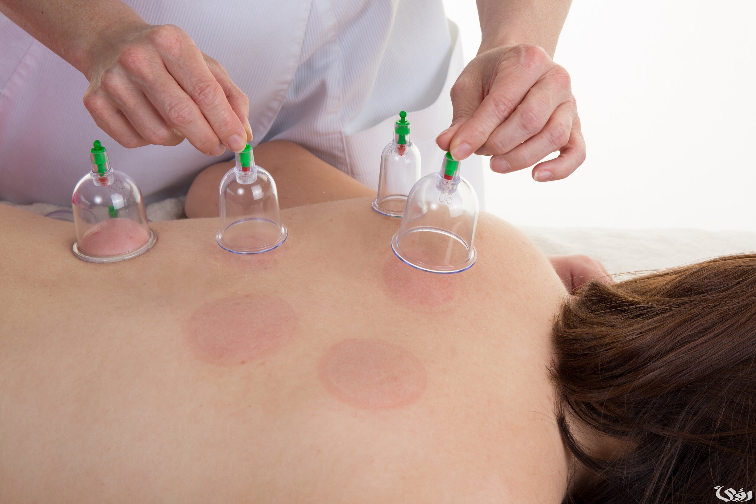 أسعار الحجامة في أفضل مراكز الكويت 2026 4 سعر الحجامة في أفضل مراكز الكويت