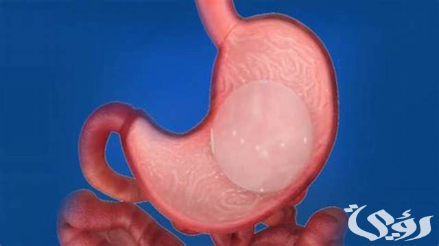 سعر كبسولة بالون المعدة في مصر