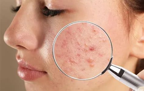 تفسير حلم رؤية ظهور البثور والحبوب فى المنام
