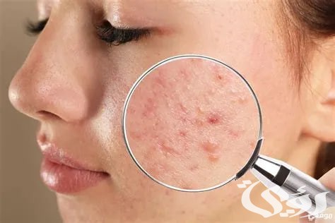 تفسير حلم رؤية ظهور البثور والحبوب فى المنام