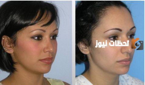 كل ما تحتاج معرفته عن تكلفة عملية تجميل الأنف في مستشفى الحبيب السعودي 1447 وكيفية الحجز