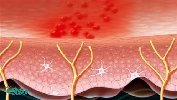 بمناسبة التوعية العالمية به.. الوقاية لا تقل أهمية عن العلاج لمرض الحزام الناري
